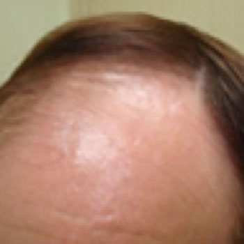 Before-Hair Loss