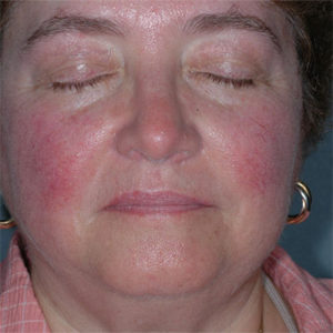 Rosacea and Red Skin – Corona Clinic