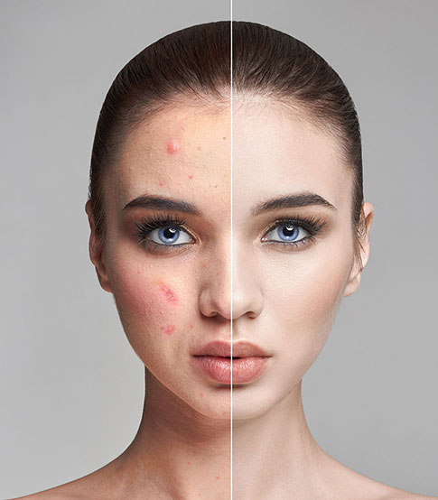 Acne & Skin Concerns