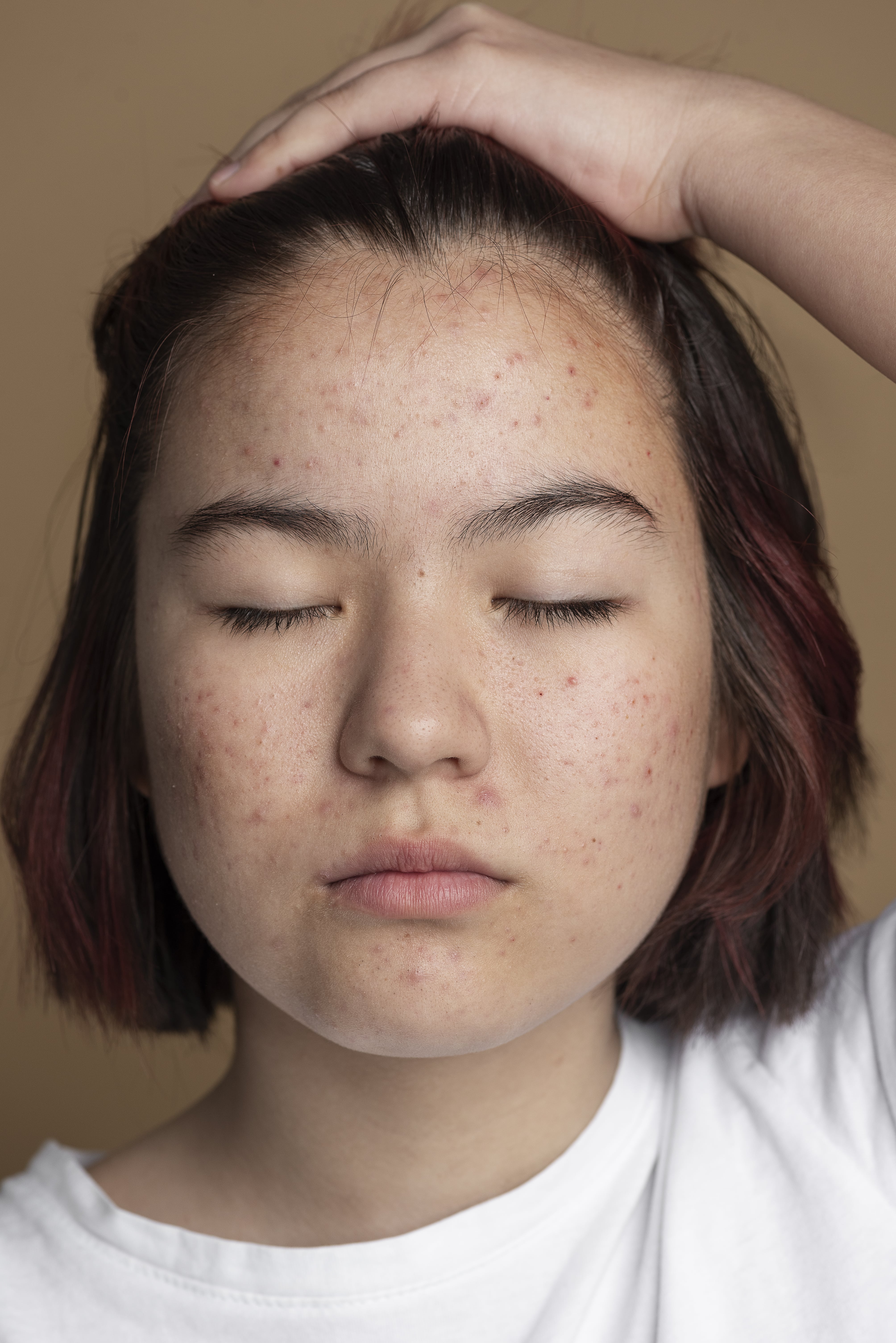Blackheads vs. Whiteheads