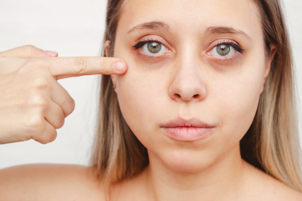 How to Reduce Dark Circles & Puffy Eyes Without Surgery
