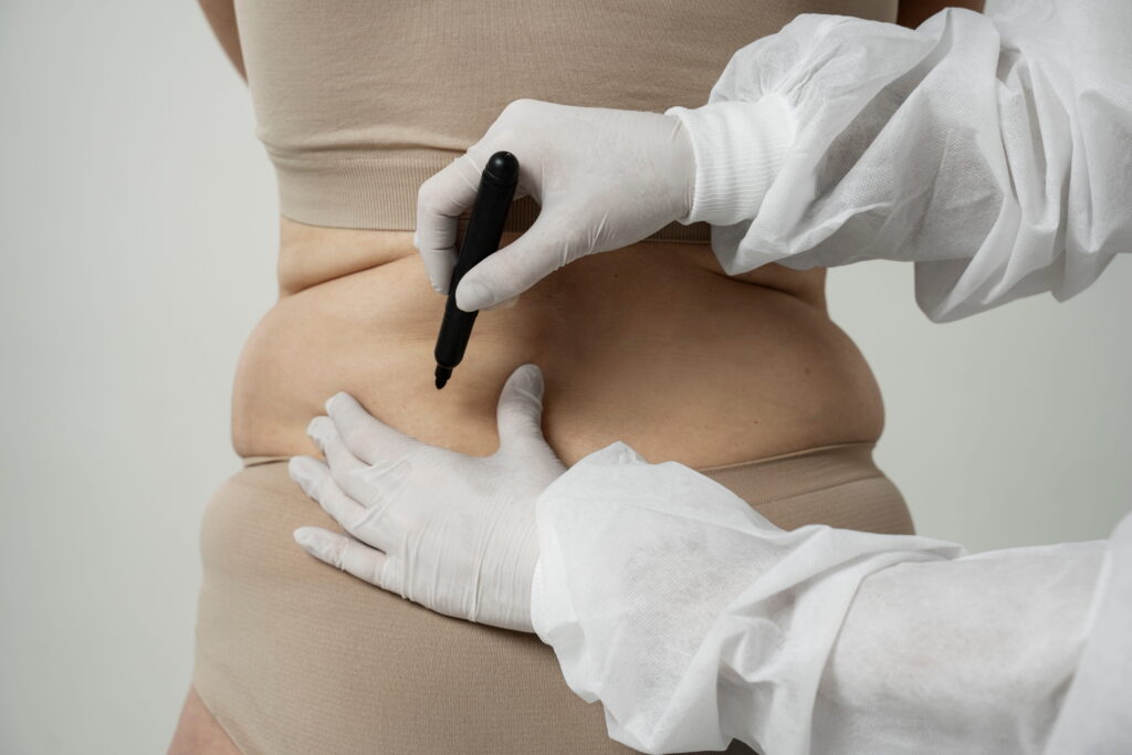 Liposuction Procedure: What to Expect and How It Helps Shape Your Body