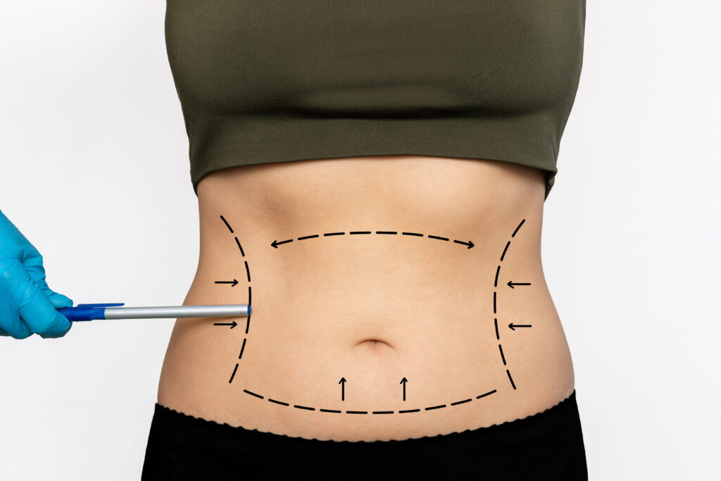 Minimally Invasive Liposuction A Modern Approach to Body Contouring